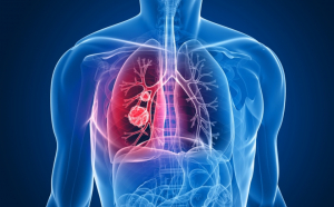  Anual, peste 12.000 de români sunt diagnosticați cu cancer pulmonar