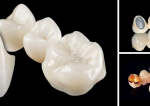  Care este diferenta dintre lucrarile dentare metalo ceramice si cele din zirconiu?