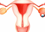 Cancerul ovarian, în creștere! Atenție la simptome!