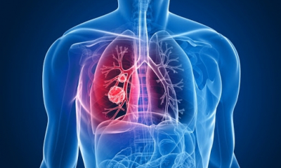 Riscul de cancer pulmonar, depistat online: cum afli dacă ești în pericol