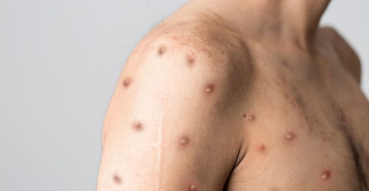 Încă un caz de variola maimuței consemnat în România
