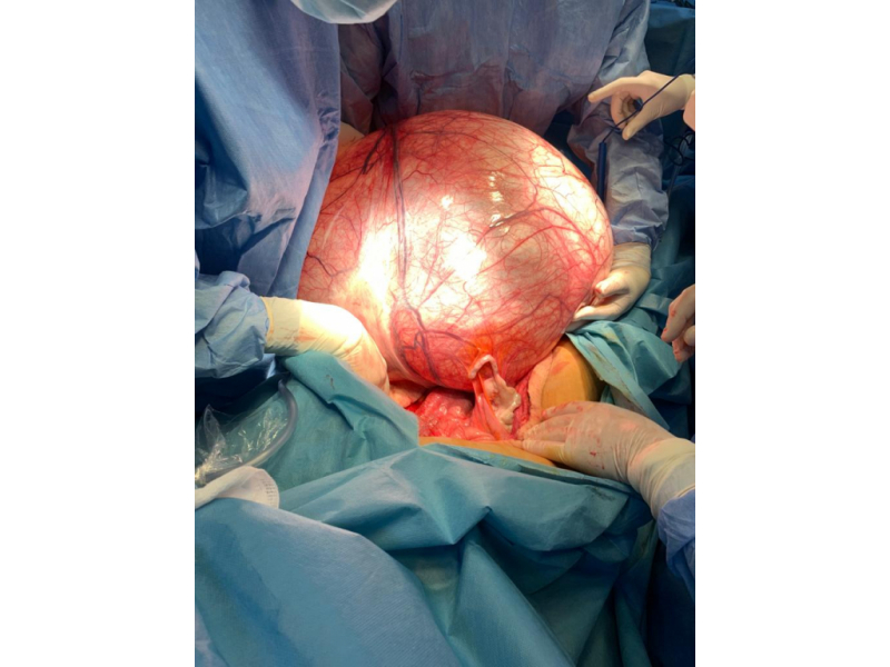 Tumoră ovariană de 6 kilograme, eliminată de către medicii de la Spitalul Militar din București