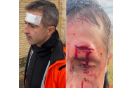 Eurodeputatul Dragoș Benea și-a spart capul. El a suferit un accident rutier