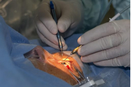 Trei transplanturi de cornee la Iași, în ultima lună