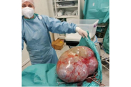 Tumoră de circa 25 kg, extirpată din abdomenul unui femei din Botoșani. Pacienta avea și COVID