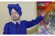 A murit de bătrânețe fetița care avea doar 10 ani. Iryna Khimich suferea de progeria și corpul său arăta ca la 80 de ani