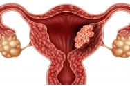 Femeile din judeţul Vaslui au şansa să se testeze gratuit pentru depistarea cancerului de col uterin