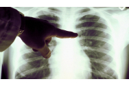  Cancerul pulmonar face ravagii printre ieşenii tineri