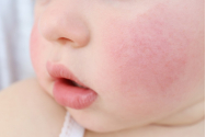 Copiii sunt mai predispusi la alergii alimentare