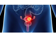 Două tipuri de cancere pot fi prevenite prin vaccinare: cancerul de col uterin şi carcinomul hepato-celular