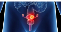 cancerul-de-col-uterin