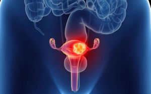 Două tipuri de cancere pot fi prevenite prin vaccinare: cancerul de col uterin şi carcinomul hepato-celular