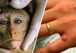 Variola maimuței. Cum acționează virusul care a stârnit panică în toată lumea