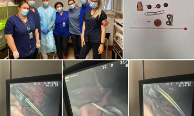 Intervenție chirurgicală inedită la Suceava - pioneze, agrafe, balamale și un termometru cu mercur au fost extrase din stomacul unui pacient