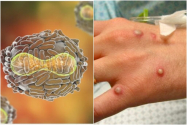 Încă trei noi cazuri de variola maimuței, în România