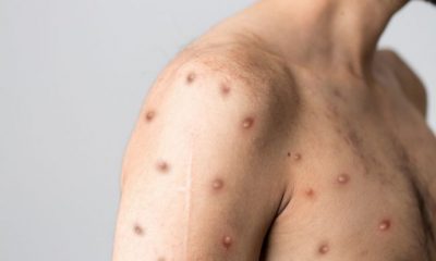 Un nou caz de variola maimuței a fost diagnosticat în România