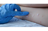 Un copil a fost infectat cu variola maimuței. Este primul caz apărut în rândul celor mici