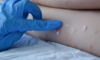Un copil a fost infectat cu variola maimuței. Este primul caz apărut în rândul celor mici