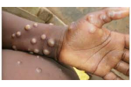 Un nou caz de variola maimuţei a fost confirmat în România