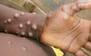 Un nou caz de variola maimuţei a fost confirmat în România