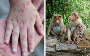 Variola maimuţei: OMS declară urgență globală de sănătate publică, cel mai înalt nivel de alertă