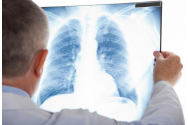 Tuberculoza face ravagii la Vaslui