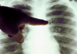 România, țara cu cei mai mulți bolnavi de TBC din UE