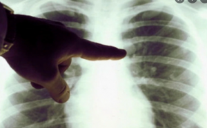 România, țara cu cei mai mulți bolnavi de TBC din UE