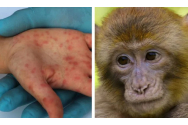 Variola maimuéi, peste 70.000 de cazuri la nivel mondial