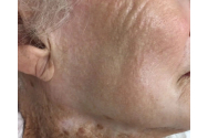O fotografie uluitoare cu pielea unei femei de 92 de ani arată efectele pe termen lung ale folosirii cremei de protecție solară pe față