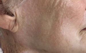 O fotografie uluitoare cu pielea unei femei de 92 de ani arată efectele pe termen lung ale folosirii cremei de protecție solară pe față