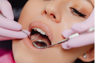 5 aspecte pe care să le ai în vedere atunci când te decizi să-ți pui implant dentar