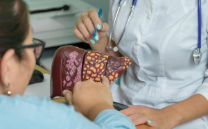 O treime dintre români riscă să facă ciroză hepatică!