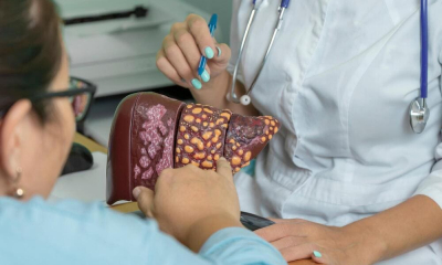 O treime dintre români riscă să facă ciroză hepatică!