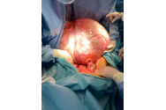 Tumoră ovariană de 6 kilograme, extirpată de medicii de la Spitalul Militar din București