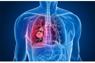  Anual, peste 12.000 de români sunt diagnosticați cu cancer pulmonar