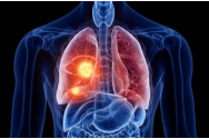 Cancerul pulmonar: mai multă mișcare, șanse mai mari de supraviețuire
