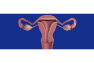 Cancer ovarian - Doar 1% dintre femei recunosc următoarele simptome